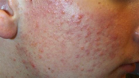 Most of the bacterial skin diseases in humans are caused by the staphylococci or staph bacteria. Skin Disorders: Pictures, Causes, Symptoms, Treatments ...