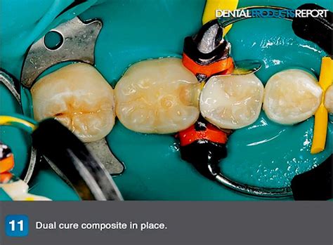 Posterior Composite Restoration Efficiently Place Posterior Direct