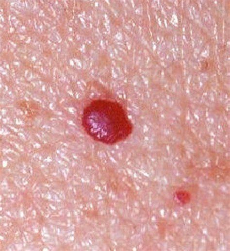 Cherry Angiomas Pictures Symptoms Causes Treatment Removal Artofit