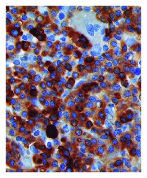 Case 2 A Bone Marrow Aspirate Reveals Large Numbers Of Download