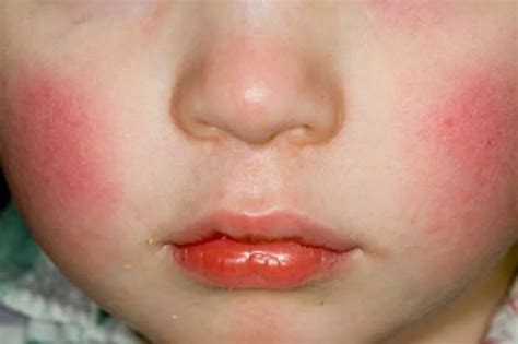 Slapped Cheek Syndrome In Essex What Symptoms To Look Out For Essex Live