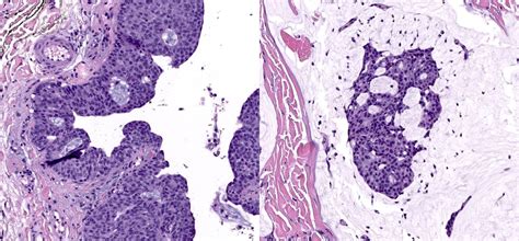 Pathology Outlines Endocrine Mucin Producing Sweat Gland Carcinoma