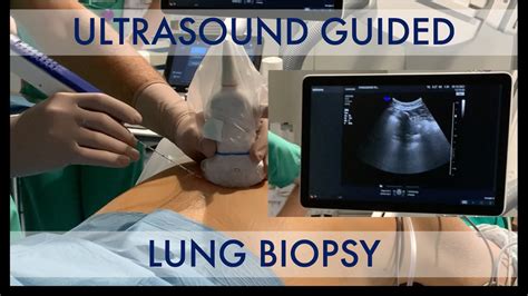 Us Guided Lung Biopsy Youtube