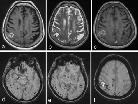 Cerebral Amyloid Angiopathy Radiology Cases