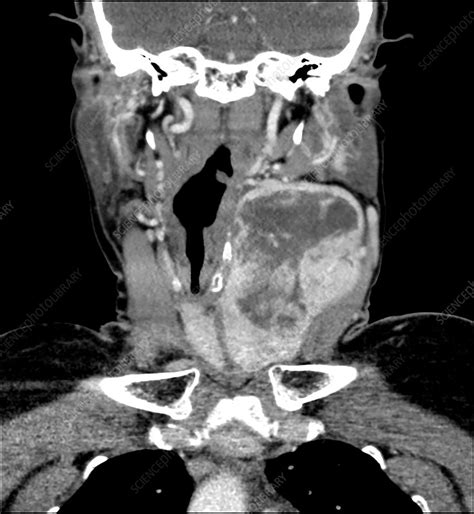 Large Thyroid Goiter Ct Stock Image C0365226 Science Photo Library