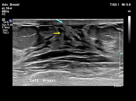 Atlas Of Breast Cancer Early Detection