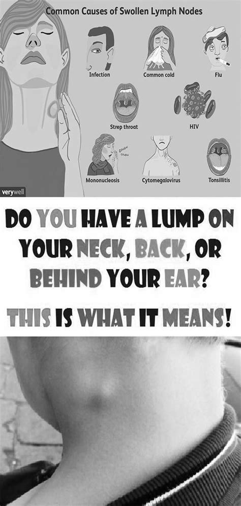 Lumps On Neck Secrets In 2020 Swollen Lymph Nodes Health And