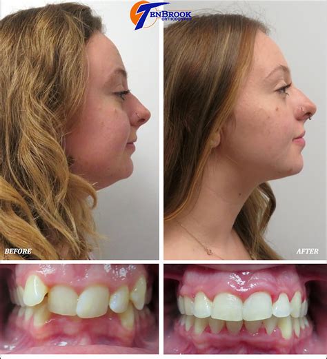 Overbite Lips Before And After Braces Lipstutorial Org