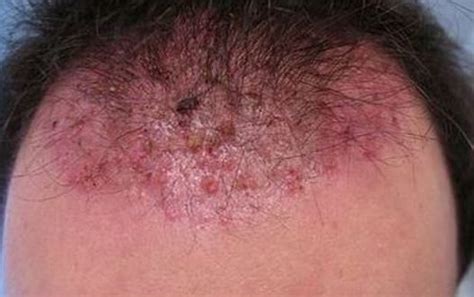 Ingrown Hair On Scalp Head Cyst Pictures Big Infected Painful