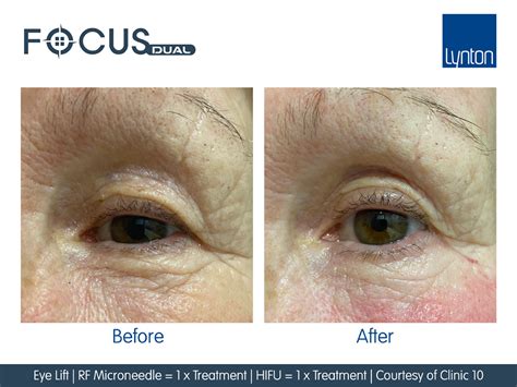 Eye Lift Before And After 1 Focus Dual Hifu And 1 Rf Microneedling