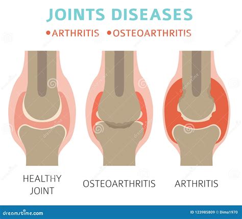 Joints Diseases Arthritis Osteoarthritis Symptoms Treatment I Stock Vector Illustration Of