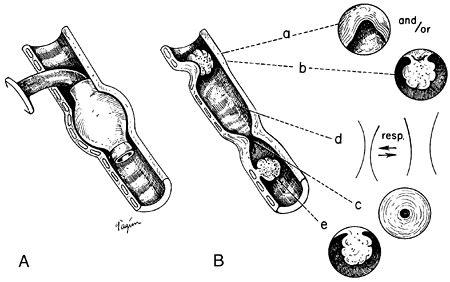 Maybe you would like to learn more about one of these? 65 - Diffuse Malignant Mesothelioma | General Thoracic ...