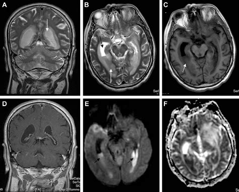 Magnetic Resonance Features Of Pyogenic Brain Abscesses And