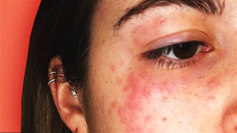Allergic Reaction Makeup Rash Tutorial Pics