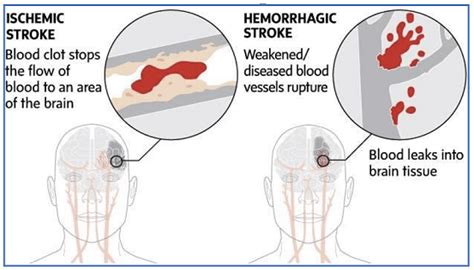 Types Of Strokes Ischemic And Hemorrhagic In Ischemic Brain Stroke Download Scientific