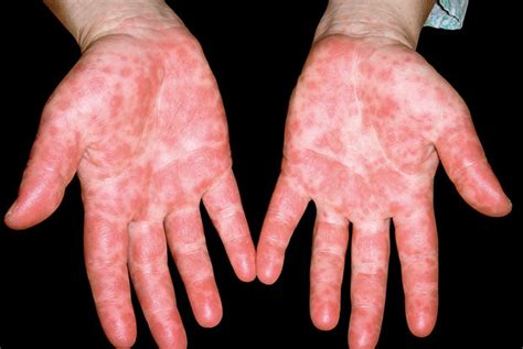Skin Conditions In Young Children Gponline