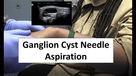 Needle Aspiration Of A Ganglion Cyst Youtube