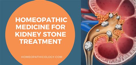 Guide Homeopathic Medicine For Kidney Stone Treatment
