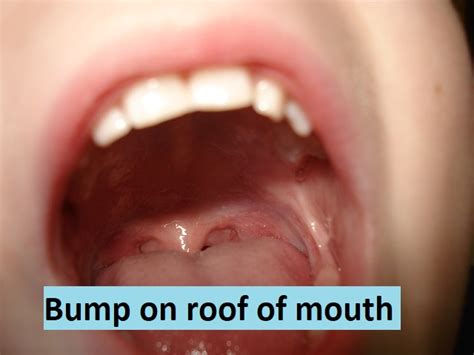 The condition starts off as a lump which is often mistaken for a cyst but is rather most of the times, these pimples start off as very tiny eruptions and then gradually grow in size till they give off the appearance of a bump. 4 Causes Of Bump On Roof Of Mouth - Market Health Beauty