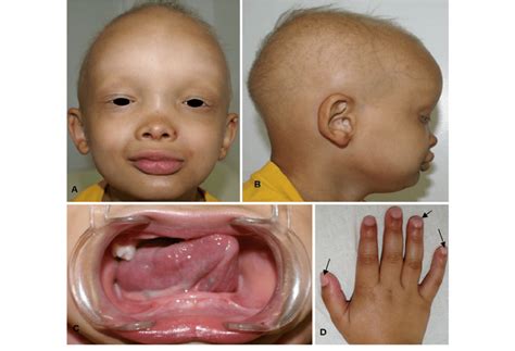 Second Case Of X Linked Hypohidrotic Ectodermal Dysplasia The Second
