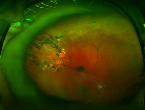 Horseshoe Tear Retina Image Bank