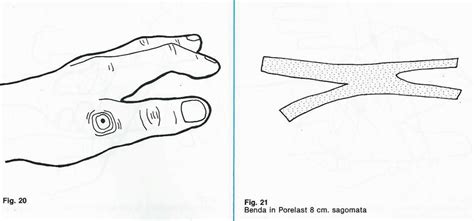 BENDAGGIO CON TAPE PER LESIONE SEGOND A BOTTONIERA E PRIMO ...
