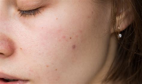 Why Do Pimples Pop Up In Clusters Proactiv®
