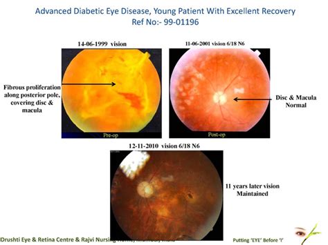 Types of diabetic eye disease. Drushti|Eye and Retina Center:-Advanced Diabetic Eye ...