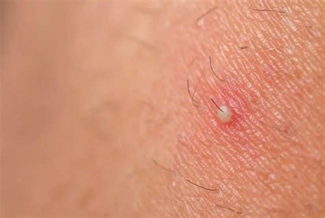 Ingrown Hair Prevention Causes Symptom And Treatment