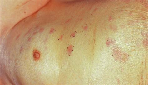 Multiple Scattered Erythema Patches On The Chest And Back Not