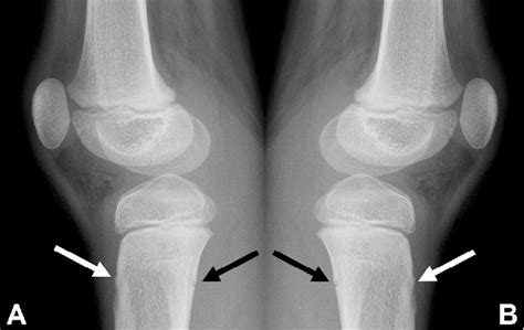 Figure 2 From Bilateral Trampoline Fracture Of The Proximal Tibia In A