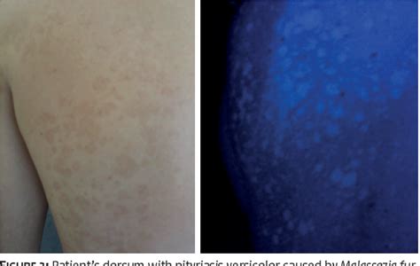 Figure 4 From Woods Lamp In Dermatology Applications In The Daily