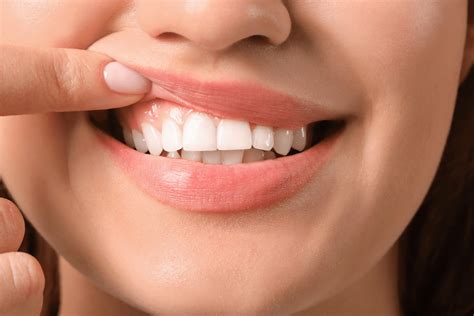 Receding Gums Treatment Everything You Should Know Flossy Blog