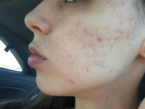 I Dont Know How To Get Rid Of This Hyperpigmentation