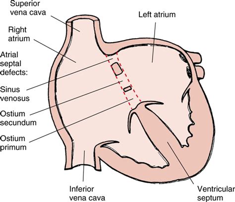 Atrial Septal Defect Atrial Septal Defect Congenital Heart Disease