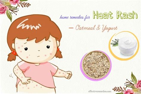 30 Best Natural Home Remedies For Heat Rash On Face And Body