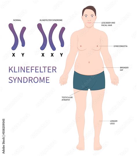 Klinefelters Syndrome Chromosomal And Inherited Disorder Stock Vector Adobe Stock