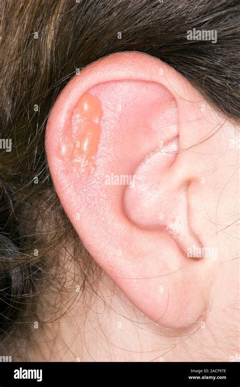 Herpes Simplex Lesion On The Pinna Of A Mans Ear Herpes Simplex Is A