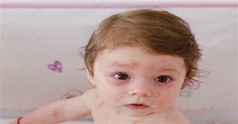 Come Si Riconosce La Dermatite Atopica Nei Bambini I Sintomi