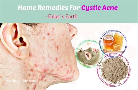 18 Best Home Remedies For Cystic Acne On Face Neck Nose Cheek Forehead