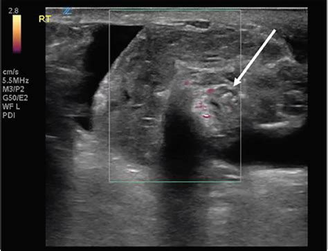 Testicular Torsion In Monorchism Diagnosed With Point Of Care Ultrasound A Case Report The