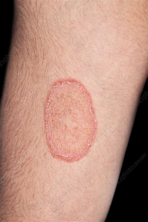 Ringworm Stock Image C0376783 Science Photo Library