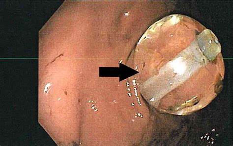 Cureus A Rare Case Of Gastric Outlet Obstruction With Severe Reflux