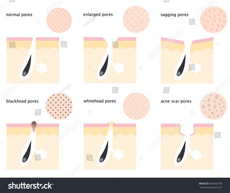 Diagram Skin Pores Normal Sagging Open 库存矢量图（免版税）464254709 Shutterstock