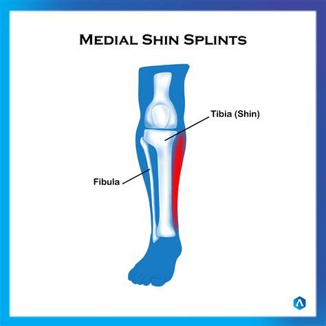 Shin Splint Medial Dr Abbie Clinics
