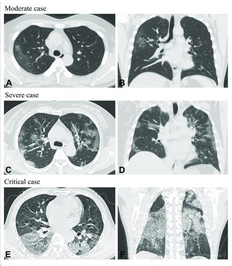 Axial Planes And Coronal Chest Ct Scans In Patients With Covid 19