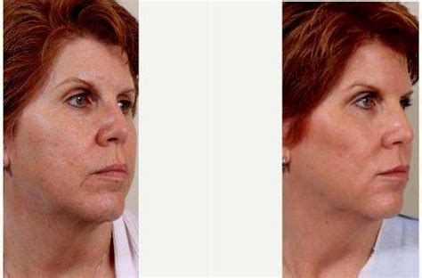 Year Old Woman Treated With Botox With Doctor Vincent N Zubowicz