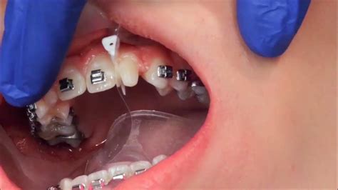 Dentist Fixing Peg Laterals With Bonding Youtube