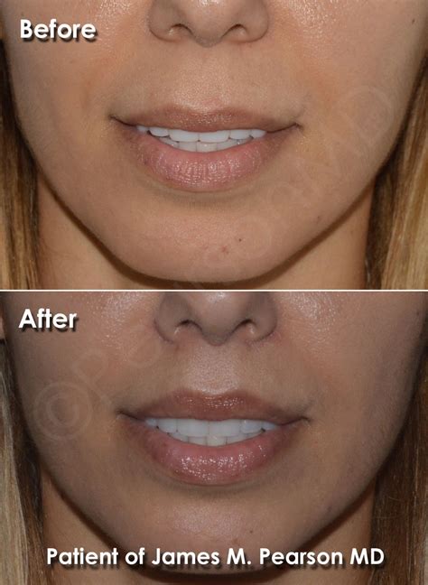 Face Plastic Surgery Lip Surgery Teeth Shape Reconstructive Surgery Facial Plastic Upper