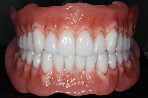 Biofunctional Prosthetic System Dentures Alux Dental